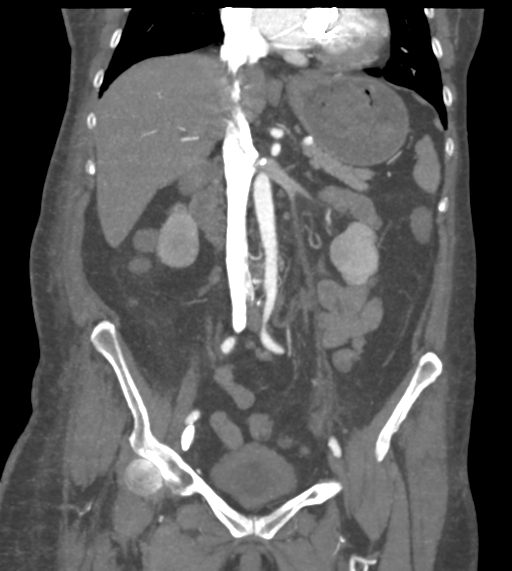 File:Acute bleed from gastric fundus biopsy site (Radiopaedia 35201-36737 Coronal C+ arterial phase 29).png