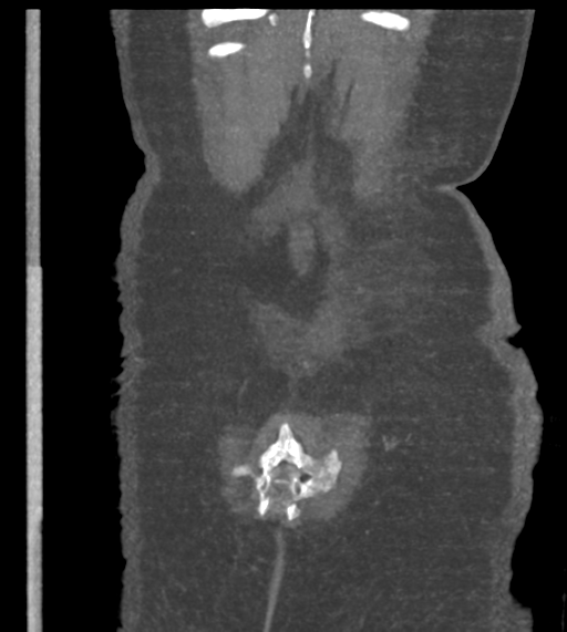 Acute bleed from gastric fundus biopsy site (Radiopaedia 35201-36737 Coronal C+ arterial phase 53).png