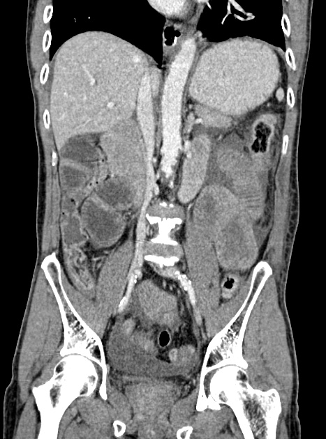 Acute bowel ischemia (Radiopaedia 87695-104114 Coronal C+ portal venous phase 218).jpg