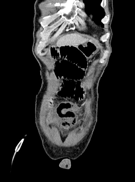Acute bowel ischemia (Radiopaedia 87695-104114 Coronal C+ portal venous phase 85).jpg