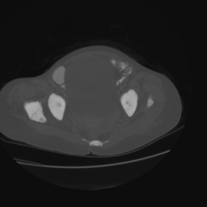 File:Acute calculous cholecystitis in patient with osteopetrosis (Radiopaedia 77871-90159 Axial bone window 45).jpg
