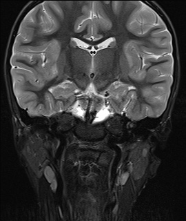 File:Acute disseminating encephalomyelitis with bilateral optic neuritis (Radiopaedia 79676-92886 Coronal STIR 21).jpg