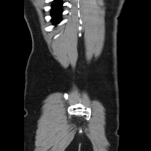 File:Acute diverticulitis with localized perforation (Radiopaedia 41296-44113 Coronal C+ portal venous phase 57).jpg