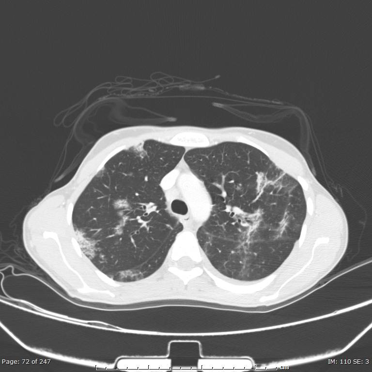 Acute eosinophilic pneumonia (Radiopaedia 48211-53073 Axial lung window 26).jpg