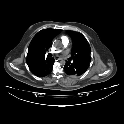 Acute heart failure (CT) (Radiopaedia 79835-93075 Axial C+ arterial phase 15).jpg