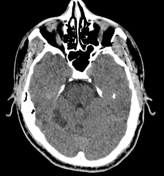 Acute ischemic stroke - posterior circulation territory (Radiopaedia 77670-89881 non-contrast 27).jpg