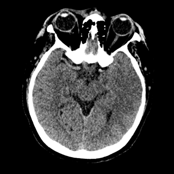Acute middle cerebral artery territory infarct (Radiopaedia 52380-58283 Axial non-contrast 42).jpg