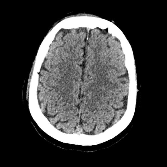 Acute middle cerebral artery territory infarct (Radiopaedia 52380-58283 Axial non-contrast 80).jpg