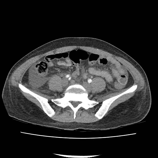Acute myocarditis (Radiopaedia 55988-62613 Axial C+ portal venous phase 52).jpg