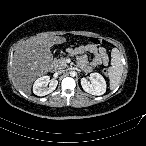 Acute on chronic pancreatitis (Radiopaedia 80902-94423 Axial C+ portal venous phase 63).jpg
