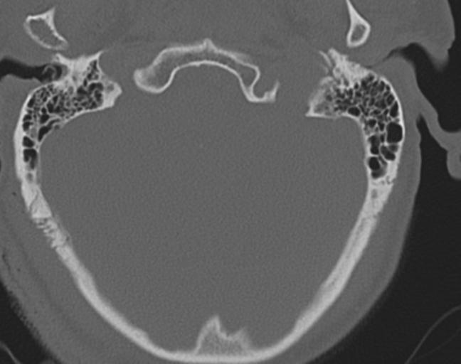 Acute on chronic subdural hematoma and thoracic vertebral injury in a multitrauma patient (Radiopaedia 31698-32619 Axial bone window 5).jpg