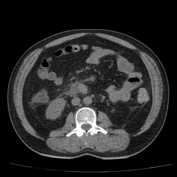 Acute pancreatitis (Radiopaedia 26663-26813 Axial non-contrast 54).jpg
