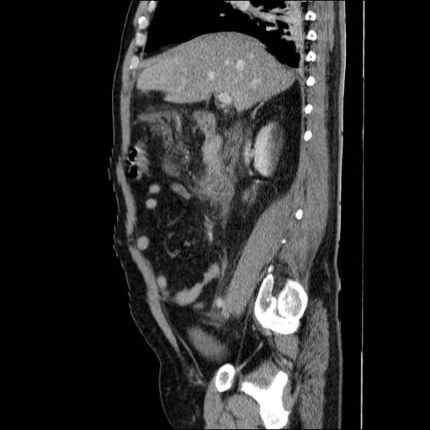 Acute pancreatitis (Radiopaedia 26663-26813 Sagittal C+ portal venous phase 28).jpg