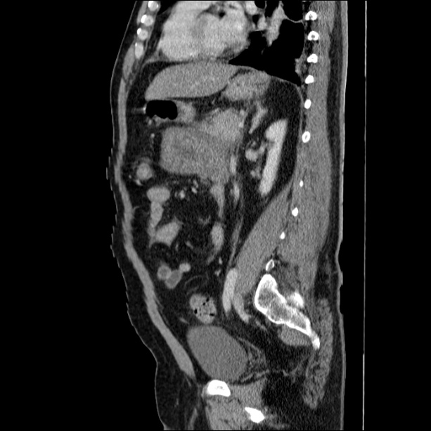 Acute pancreatitis (Radiopaedia 26663-26813 Sagittal C+ portal venous phase 47).jpg