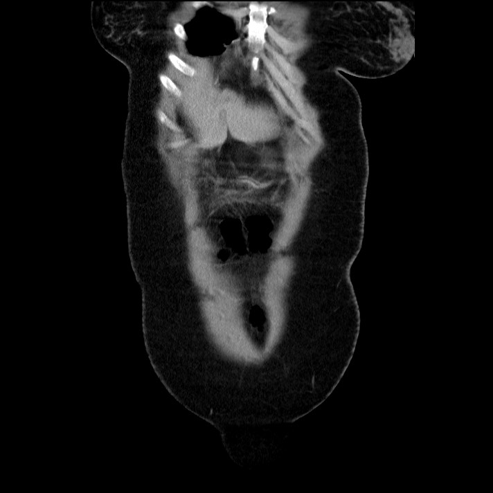 Acute pancreatitis (Radiopaedia 69236-79012 Coronal C+ portal venous phase 62).jpg