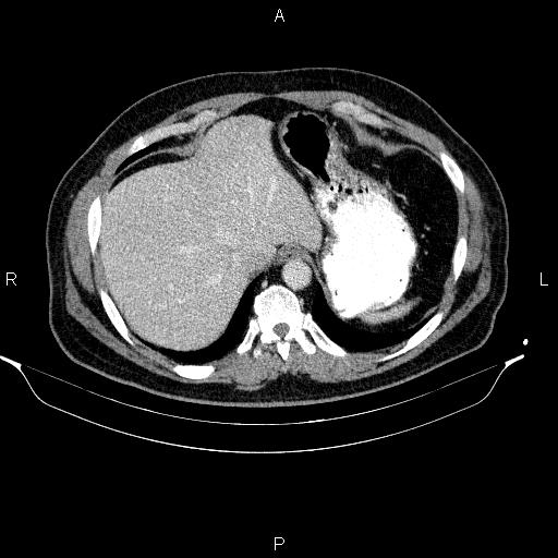 Acute pancreatitis (Radiopaedia 85390-101010 Axial C+ portal venous phase 16).jpg
