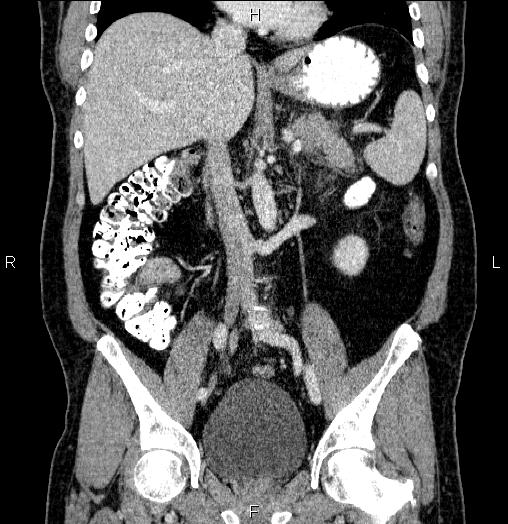 Acute pancreatitis (Radiopaedia 85390-101010 Coronal C+ portal venous phase 38).jpg