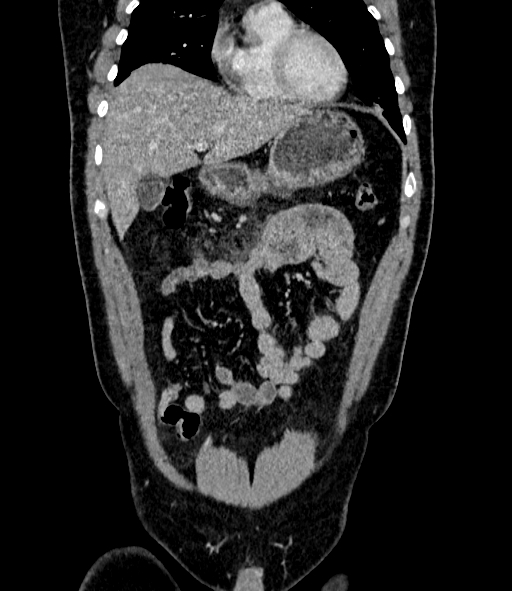 Acute pancreatitis (Radiopaedia 87428-103757 Coronal C+ portal venous phase 26).jpg