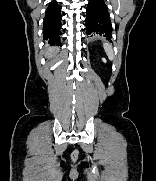 Acute pancreatitis (Radiopaedia 87428-103757 Coronal C+ portal venous phase 78).jpg