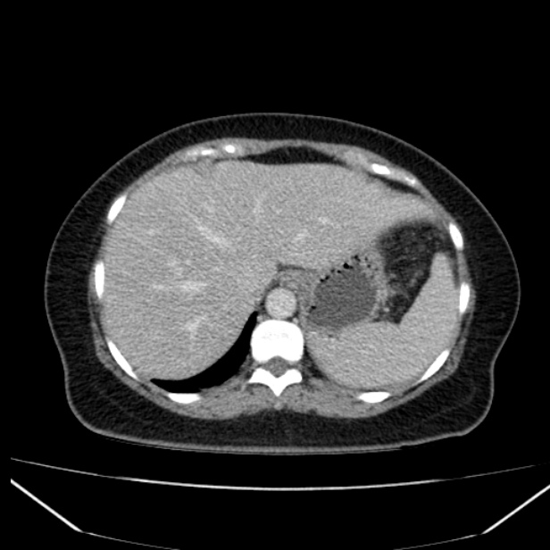 Acute pancreatitis - Balthazar C (Radiopaedia 26569-26714 Axial C+ portal venous phase 25).jpg