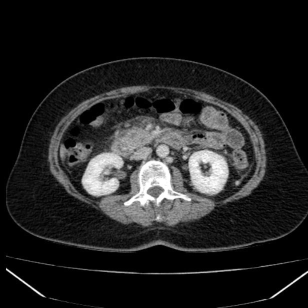 Acute pancreatitis - Balthazar C (Radiopaedia 26569-26714 Axial C+ portal venous phase 47).jpg
