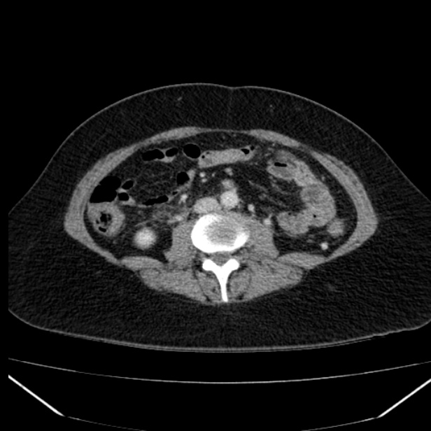 Acute pancreatitis - Balthazar C (Radiopaedia 26569-26714 Axial C+ portal venous phase 56).jpg
