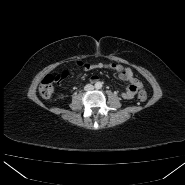 Acute pancreatitis - Balthazar C (Radiopaedia 26569-26714 Axial C+ portal venous phase 59).jpg