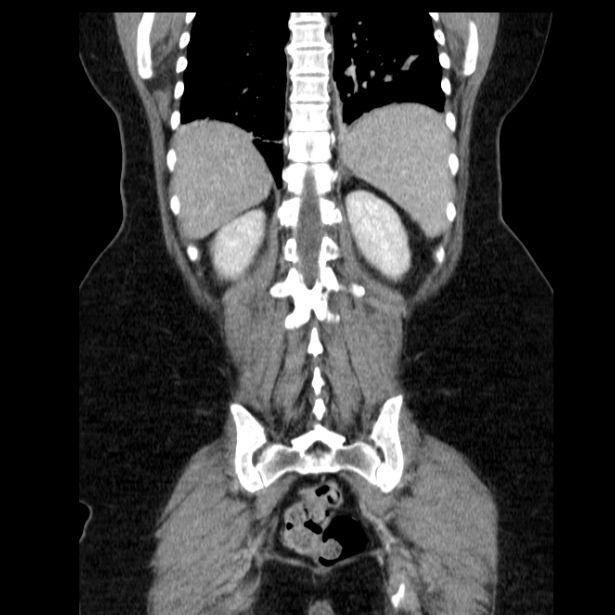 Acute pancreatitis - Balthazar C (Radiopaedia 26569-26714 Coronal C+ portal venous phase 53).jpg