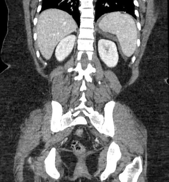 Acute pancreatitis - Balthazar E (Radiopaedia 29016-29377 Coronal C+ portal venous phase 68).png