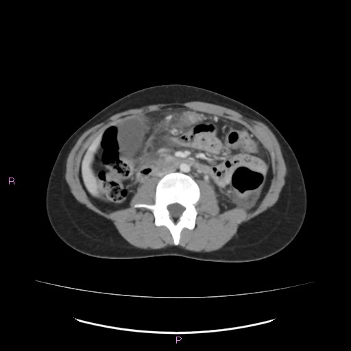 Acute pancreatitis secondary to stone at minor papilla and pancreatic divisum (Radiopaedia 76570-88333 Axial C+ portal venous phase 38).jpg