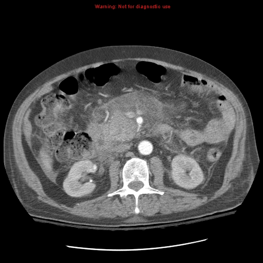 Acute pancreatitis with incidental pancreatic lipoma (Radiopaedia 10190-10730 Axial C+ arterial phase 48).jpg