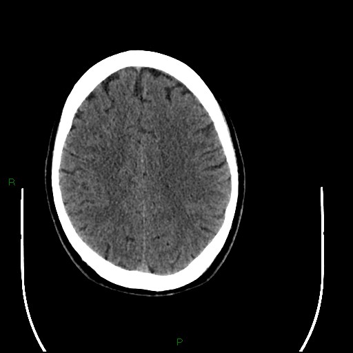 Acute posterior cerebral artery territory infarct (Radiopaedia 79329-92393 Axial non-contrast 77).jpg