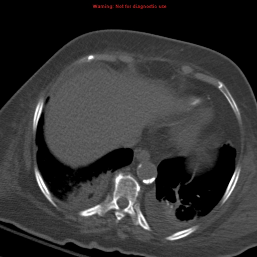 Acute pulmonary embolism (Radiopaedia 13286-13289 Axial C+ CTPA 54).jpg