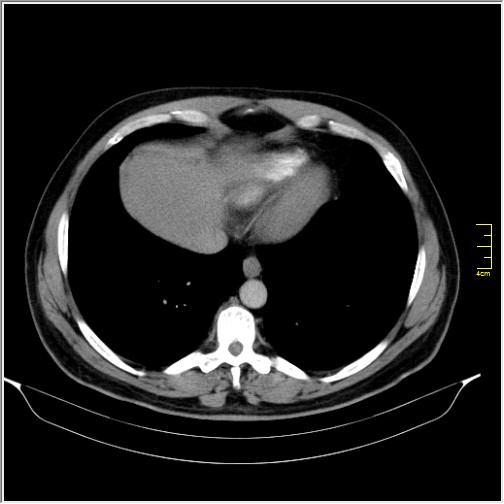 File:Acute right sided diverticulitis (Radiopaedia 65249-74268 Axial C+ portal venous phase 4).JPG