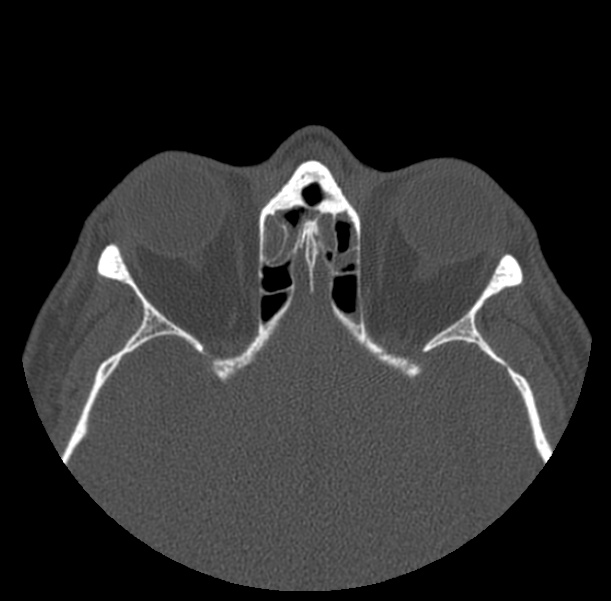 Acute sinusitis (Radiopaedia 23161-23215 Axial bone window 52).jpg