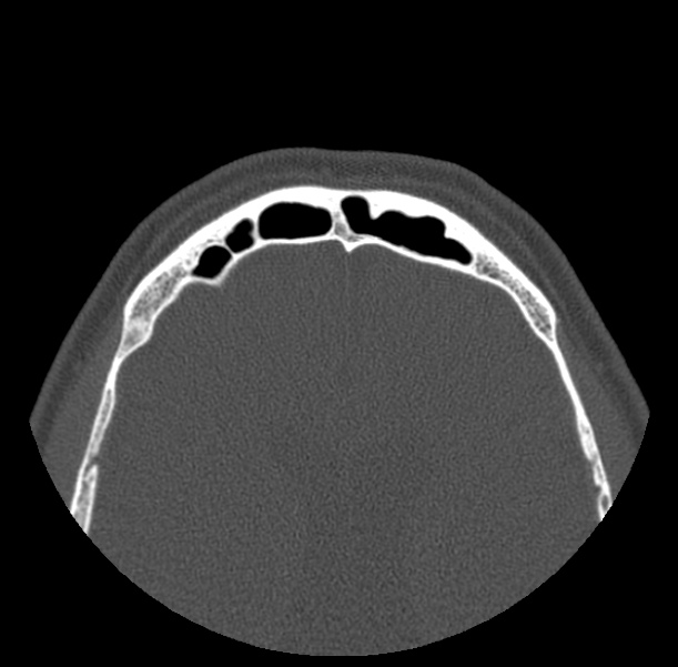 Acute sinusitis (Radiopaedia 23161-23215 Axial bone window 72).jpg