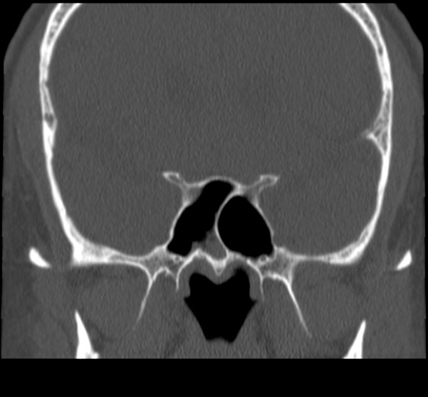 File:Acute sinusitis (Radiopaedia 23161-23215 Coronal bone window 49).jpg