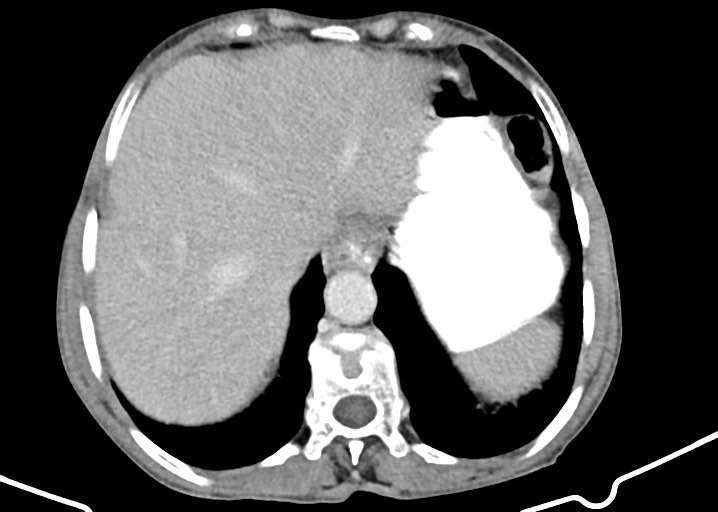 Acute small bowel (ileal) volvulus (Radiopaedia 71740-82139 Axial C+ portal venous phase 48).jpg