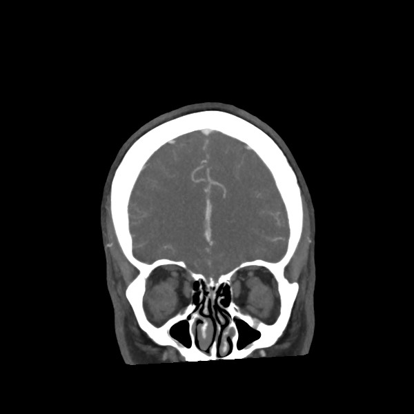 Acute subarachnoid hemorrhage and accessory anterior cerebral artery (Radiopaedia 69231-79009 Coronal C+ arterial phase 21).jpg