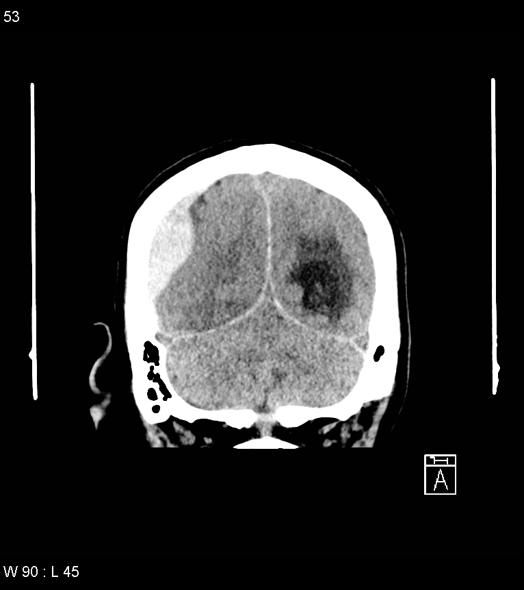 Acute subdural hematoma with myelofibrosis (Radiopaedia 52582-58494 Coronal non-contrast 44).jpg