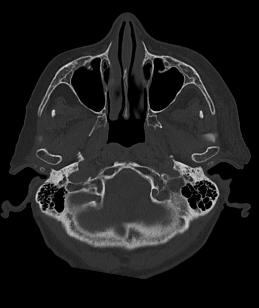 Acute traumatic subdural hematoma (Radiopaedia 82921-97257 Axial bone window 92).jpg