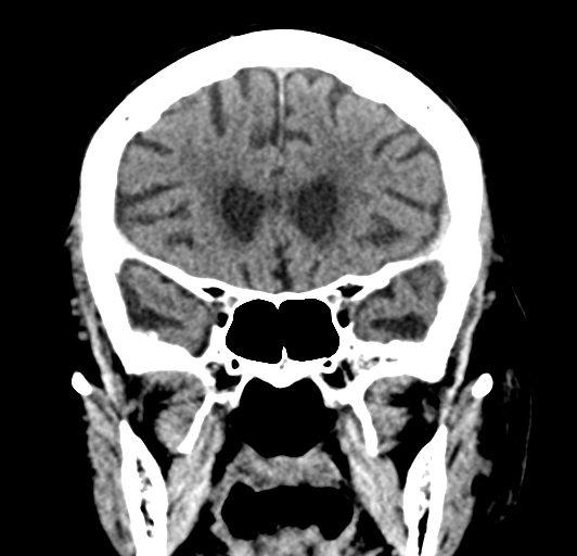 File:Acute traumatic subdural hematoma (Radiopaedia 82921-97257 Coronal non-contrast 36).jpg
