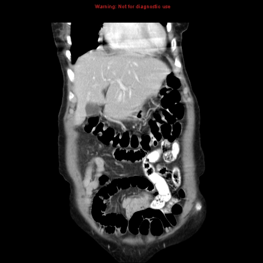 File:Adenocarcinoma of the colon (Radiopaedia 8191-9039 Coronal liver window 11).jpg