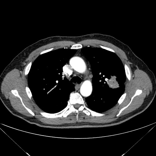 File:Adenocarcinoma of the lung (Radiopaedia 59871-67325 Axial C+ arterial phase 32).jpg