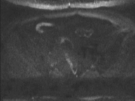 Adenocarcioma of rectum- T1 lesion (Radiopaedia 36921-38546 Axial DWI 50).png