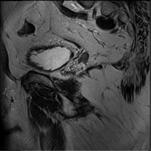 File:Adenocarcioma of rectum- T1 lesion (Radiopaedia 36921-38546 Sagittal T2 5).png