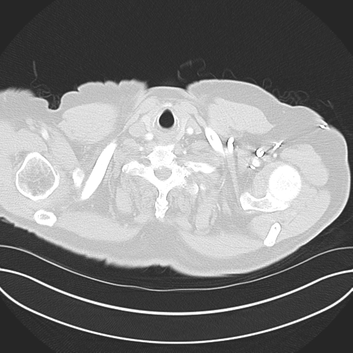 Adenocarcioma of rectum- T1 lesion (Radiopaedia 36921-38547 Axial lung window 4).png