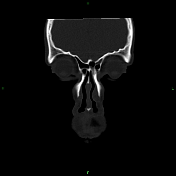 File:Adenoid cystic carcinoma of hard palate (Radiopaedia 26137-26273 Coronal bone window 2).jpg