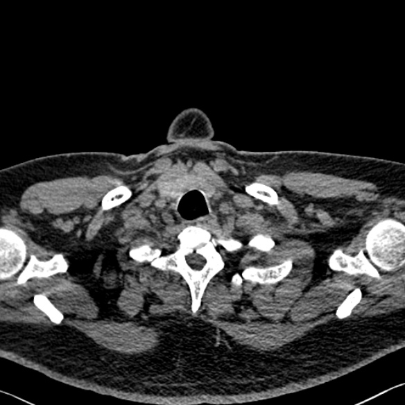 Adenoid cystic carcinoma of the trachea (Radiopaedia 49042-54137 Axial non-contrast 12).jpg