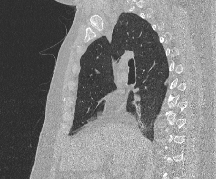 Adenoid cystic carcinoma of the trachea (Radiopaedia 49042-54137 Sagittal lung window 197).jpg